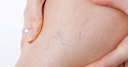 A fase inicial das varices nas pernas