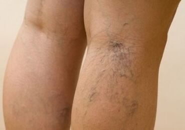 Varices