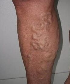 Veinas varices fundidas