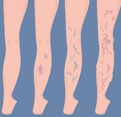 Varices