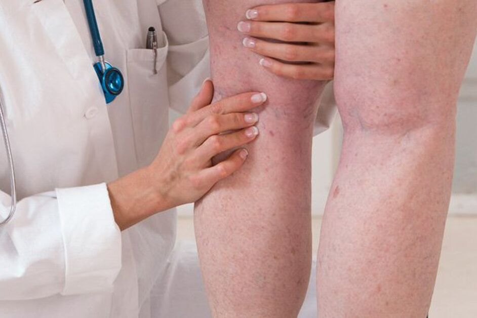 Tratamento de varices