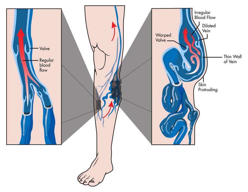 Varices