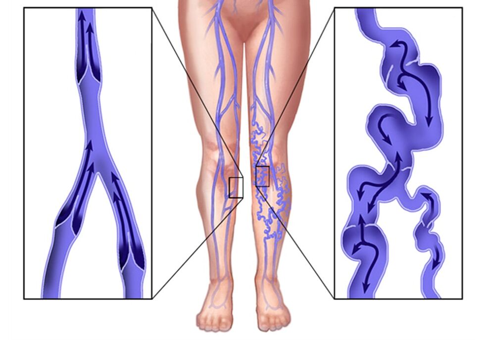 Como se ven varices
