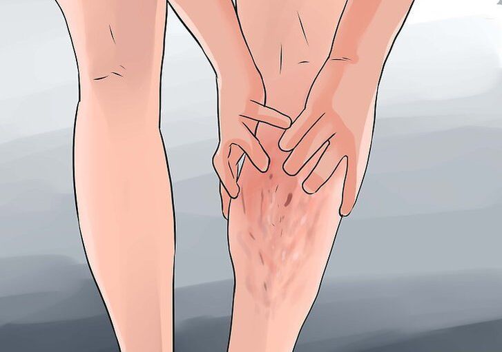 Varices na perna