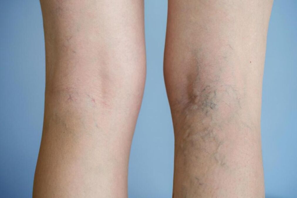 Varices