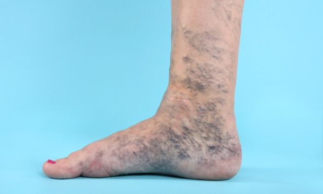 Veinas fortes de varices