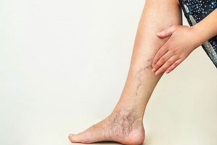 Varices
