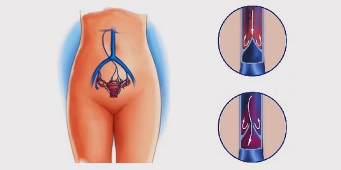 Por que se desenvolven varices na zona pélvica