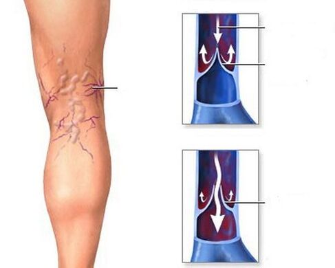 Consecuencias das varices nas pernas