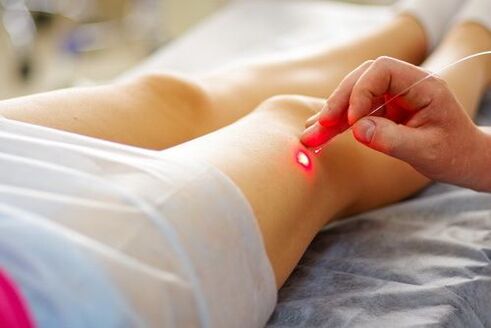 Tratamento de varices